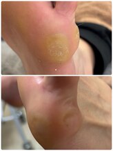 リゼラアンドコー 柏原店/痛いタコ！