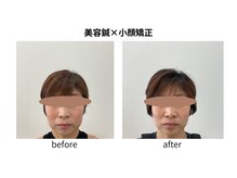 ブライト鍼灸整体院(Bright鍼灸整体院)/美容鍼　小顔矯正　リフトアップ