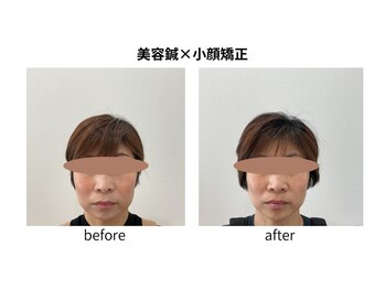 ブライト鍼灸整体院(Bright鍼灸整体院)/美容鍼　小顔矯正　リフトアップ