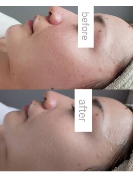 プシュケ(Psyche)/お客様の肌変化