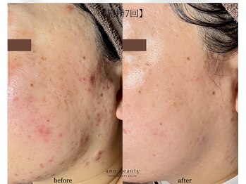 アン ビューティー(ann beauty)の写真/医師監修"乳酸ピーリング"最新韓国肌管理◎ララピールの10倍効果《ダクトピール》×ヒト幹エクソソーム導入