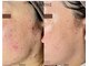 アン ビューティー(ann beauty)の写真/医師監修"乳酸ピーリング"最新韓国肌管理◎ララピールの10倍効果《ダクトピール》×ヒト幹エクソソーム導入