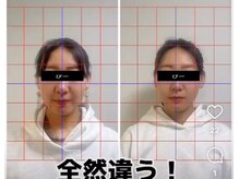 エーケー(AK)/小顔コース。超短時間で小顔に。