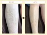 学割U24限定！人気のコラーゲン脱毛！！脇＋膝下7500円→4900円！