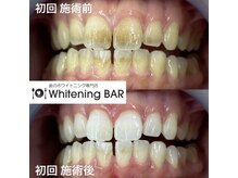 ホワイトニングバー アティ郡山店/初回ビフォーアフターをご紹介