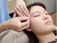 ルクス/美容鍼でお顔のお悩みも改善！