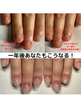 クウ(KUU)/深爪矯正→爪育成
