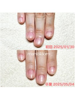 マニブルーム/深爪矯正