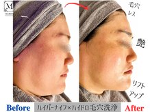 マリス(MARISS)/毛穴洗浄×小顔ハイパーナイフ