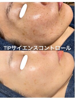 白雲木/シミでお悩みの方へ