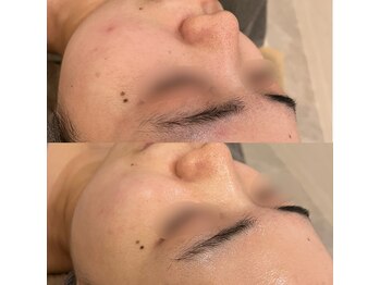 ラドンナ(LA DONNA)/毛穴ケア