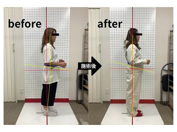 ほねつぎ龍ヶ崎はりきゅう接骨院/【産後骨盤矯正】before/after