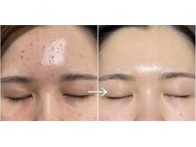 ピエル 柏店(PIEL)/徹底的に肌質改善