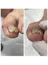 スマートリフト 五反田 大崎店(SMART LIFT)/巻き爪改善施術【大崎/五反田】