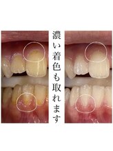 リトリート(Retreat)/ホワイトニング