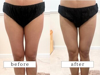 ビューティズムラウンジ(Beautism Lounge)/部分メニュー（太もも）