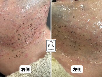 フィズ 多摩センター店(FIS)/☆脱毛施術後のポップアップ現象