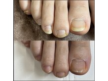 リリ(lili)/フットネイルスキンケア2回目