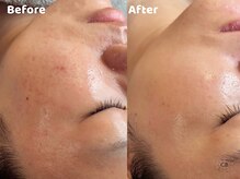 クリスタルビューティ 渋谷/【LHALALAララピール】