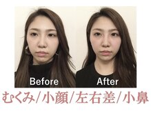 顔と鼻を同時に整えます！盛岡/小顔/小顔矯正