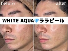 ホワイトアクア 柏店(WHITE AQUA)/ララピール/メンズケア/肌質改善