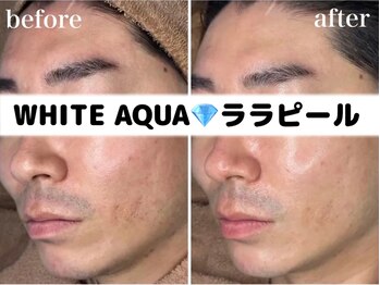 ホワイトアクア 柏店(WHITE AQUA)/ララピール/メンズケア/肌質改善