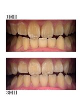 ホワイトニングショップ 三田店/Before After/3回