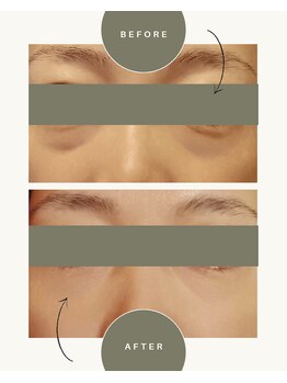 ソヨリプラス(Soyory Plus)/目の下のクマ、たるみを改善