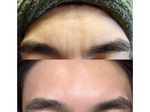 スキンスキン(SKINSKIN)/シワ改善効果