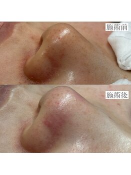 ライカブルー(RaicA BluE)/施術写真　before-after