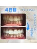【歯科提携ジェル】プレミアムホワイトニング5回分チケット