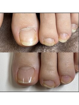 リリ(lili)/フットネイルスキンケア2回目