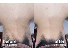 シェアサロン レノール(SHARE SALON LENORL)/【momiji】うなじ・背中脱毛