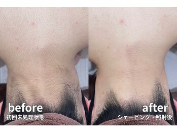 シェアサロン レノール(SHARE SALON LENORL)/【momiji】うなじ・背中脱毛