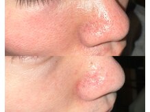 ル シーニュ/毛穴エクストラクション