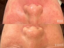 ウォーム(warm)/肌質改善/岡山/フェイシャル