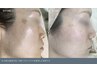【１ヵ月以内の再来】透明感肌を育む　ホワイトピーリング