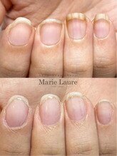 マリーロール 梅田店(Marie Laure)/自爪育成/深爪矯正/ネイルケア