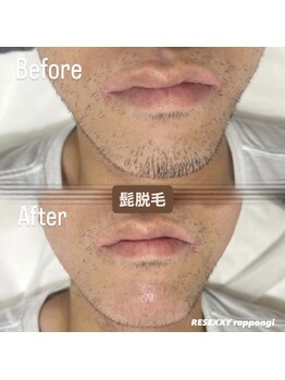 リゼクシー INTERNATIONAL麻布十番 六本木(RESEXXY)/髭脱毛　目安30分