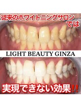 ライトビューティー 銀座店(LightBeauty)/東銀座 ホワイトニング 症例写真