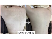 スキンハピネス(skinhappiness)/背中ハーブピーリングケア