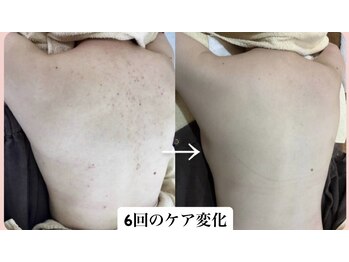 スキンハピネス(skinhappiness)/背中ハーブピーリングケア