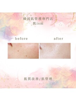 肌イズム つくば店(肌ism)/【before＆after】ララピール