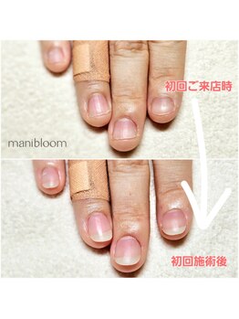 マニブルーム/深爪矯正/長さ出し
