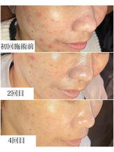 ブラックボックス(BLACK BOX)/ハーブピーリング3回+陶肌ピール