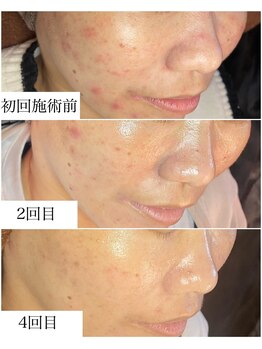 ブラックボックス(BLACK BOX)/ハーブピーリング3回+陶肌ピール