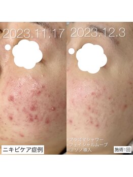 イリス(Iris)/ニキビケアには！