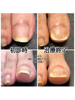 キラキラフット神領 ありが接骨院/巻き爪/フットケア