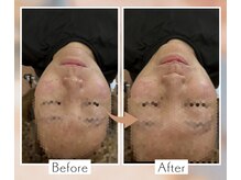 くすの木 治療院/むくみとフェイスライン