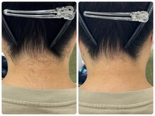 アロンジェファム(allonge femme)の雰囲気(結果のでる最新機種【うなじ脱毛】高評です1パーツ 1,900円)